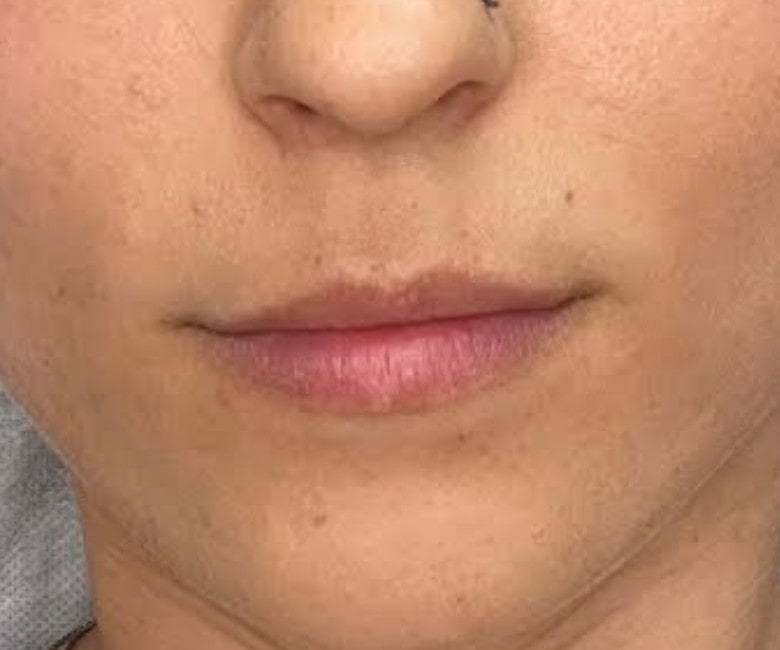 Lip Blush Before Picture